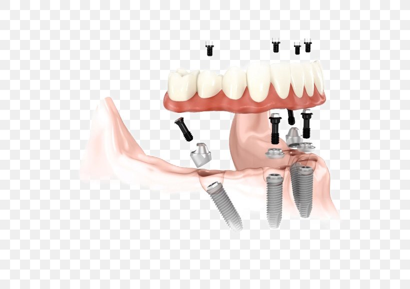 Dental Implant Abutment Dentistry Dentures, PNG, 631x579px, Dental Implant, Abutment, Cosmetic Dentistry, Crown, Dentist Download Free