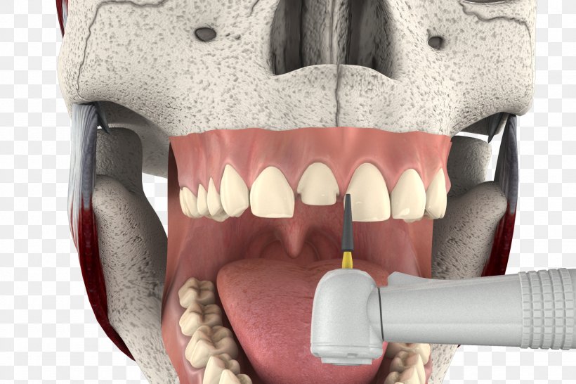 Tooth Veneer Cosmetic Dentistry Mouth Jaw, PNG, 1920x1280px, Watercolor, Cartoon, Flower, Frame, Heart Download Free