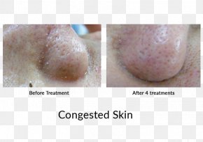 Algae - Chin Jaw Finger Disease Skin PNG