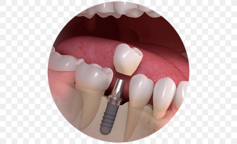 Dental Implant Dentistry Bridge, PNG, 500x500px, Watercolor, Cartoon, Flower, Frame, Heart Download Free
