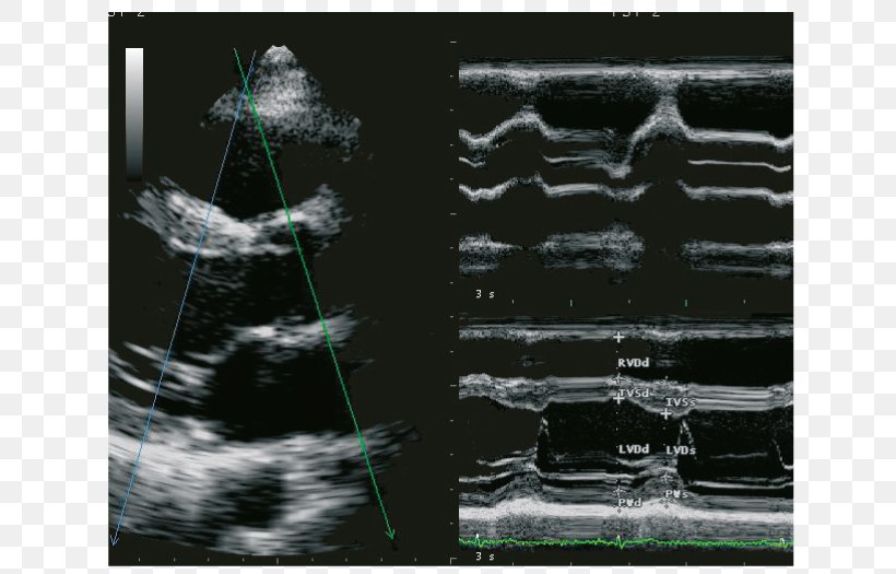 Ultrasonography Ultrasound Cardiology Ecógrafo Radiology, PNG, 700x525px, Ultrasonography, Anatomy, Black And White, Cardiology, Clinic Download Free