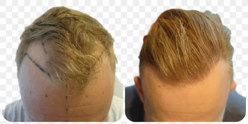 Hair Transplantation Follicular Unit Extraction Blond Graft, PNG, 1200x600px, Hair Transplantation, Blond, Chin, Ear, Eyebrow Download Free