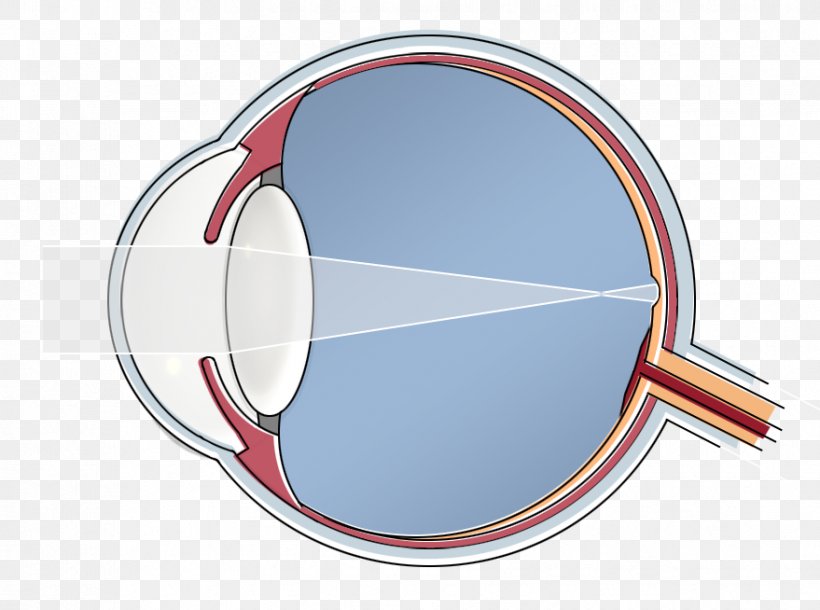 Epi-LASIK Human Eye Hypermetropia Blind Spot, PNG, 879x654px, Epilasik, Blind Spot, Cornea, Eye, Glasses Download Free