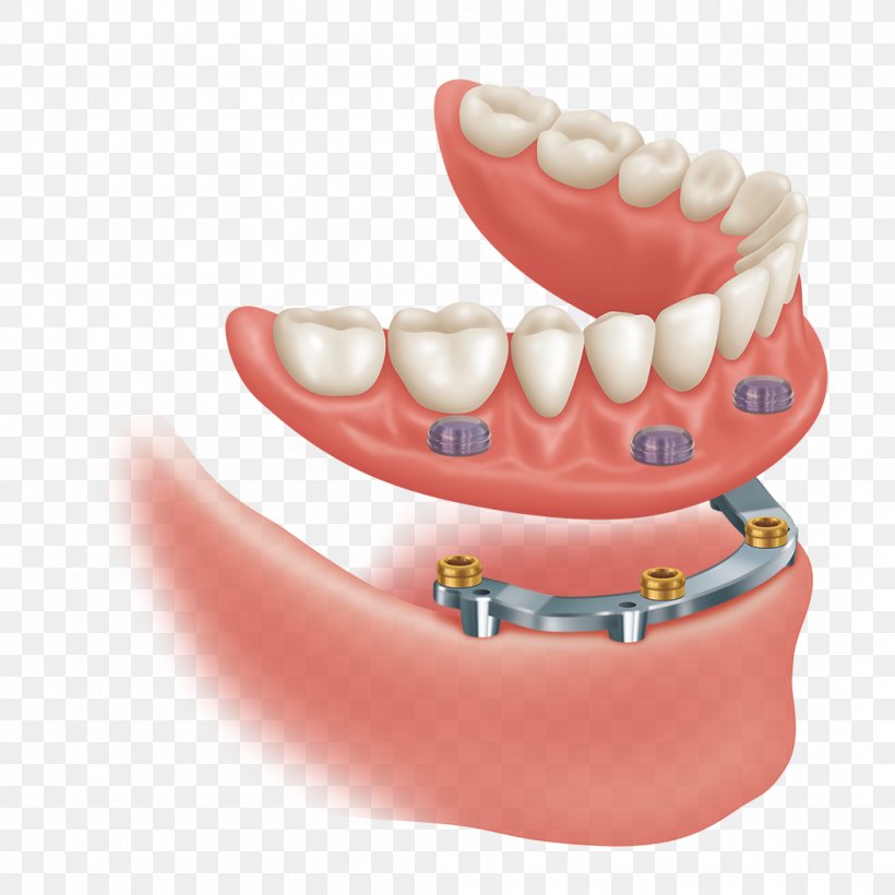 Abutment Dental Implant Dentistry Precision Attachment Dentures, PNG, 1050x1050px, Abutment, Cadcam Dentistry, Crown, Dental Implant, Dental Laboratory Download Free