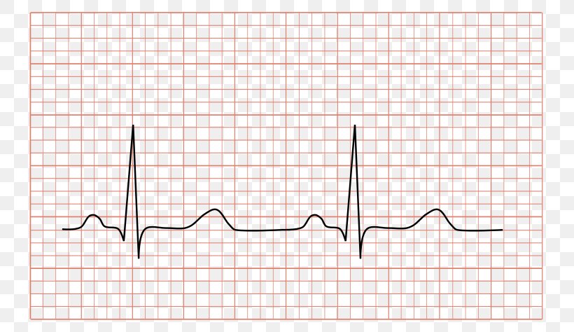Dynamic Electrocardiography Sinus Rhythm QRS Complex Cardiology, PNG, 800x474px, Watercolor, Cartoon, Flower, Frame, Heart Download Free