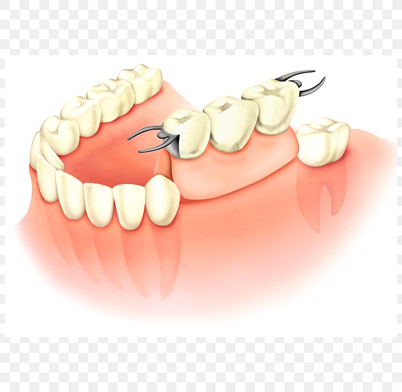 Tooth Dentures Dental Implant Prosthesis Dentistry, PNG, 800x800px, Tooth, Bridge, Dental Implant, Dental Laboratory, Dental Restoration Download Free
