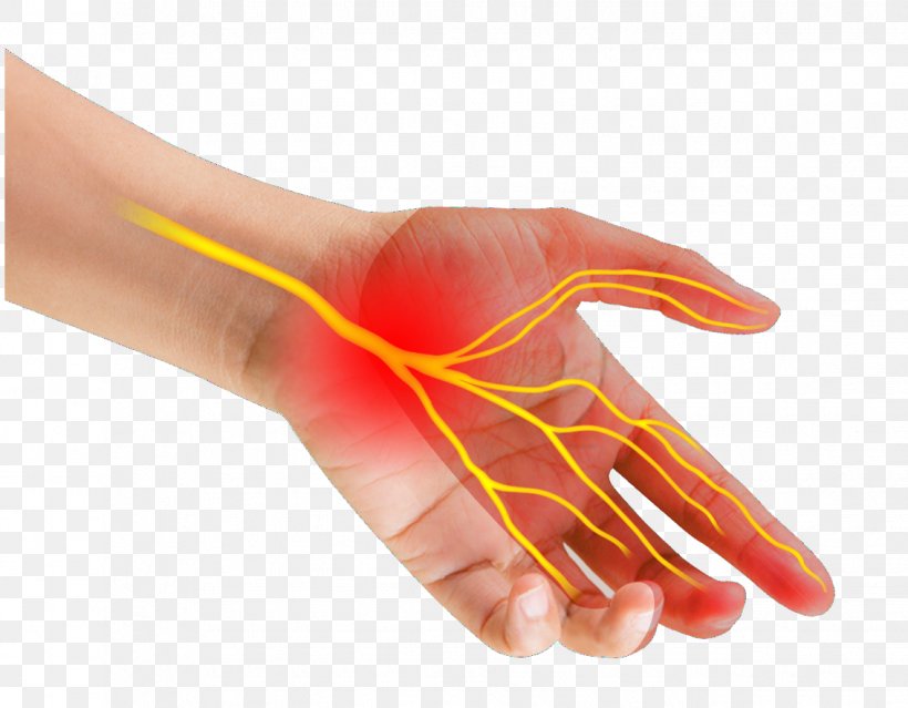 Thumb Carpal Tunnel Syndrome Median Nerve Wrist, PNG, 1134x884px, Thumb, Carpal Bones, Carpal Tunnel, Carpal Tunnel Syndrome, Compression Download Free