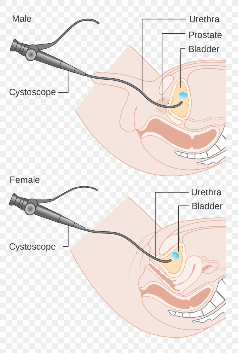 Cystoscopy Ureteroscopy Endoscopy Medical Procedure Surgery, PNG, 948x1403px, Watercolor, Cartoon, Flower, Frame, Heart Download Free