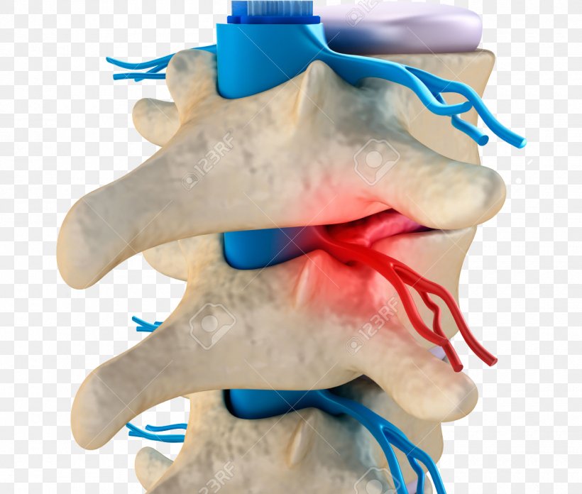 Vertebral Column Vertebral Subluxation Spinal Disc Herniation Cervical Vertebrae, PNG, 1300x1104px, Vertebral Column, Cervical Vertebrae, Chiropractic, Facet Joint, Intervertebral Disc Download Free