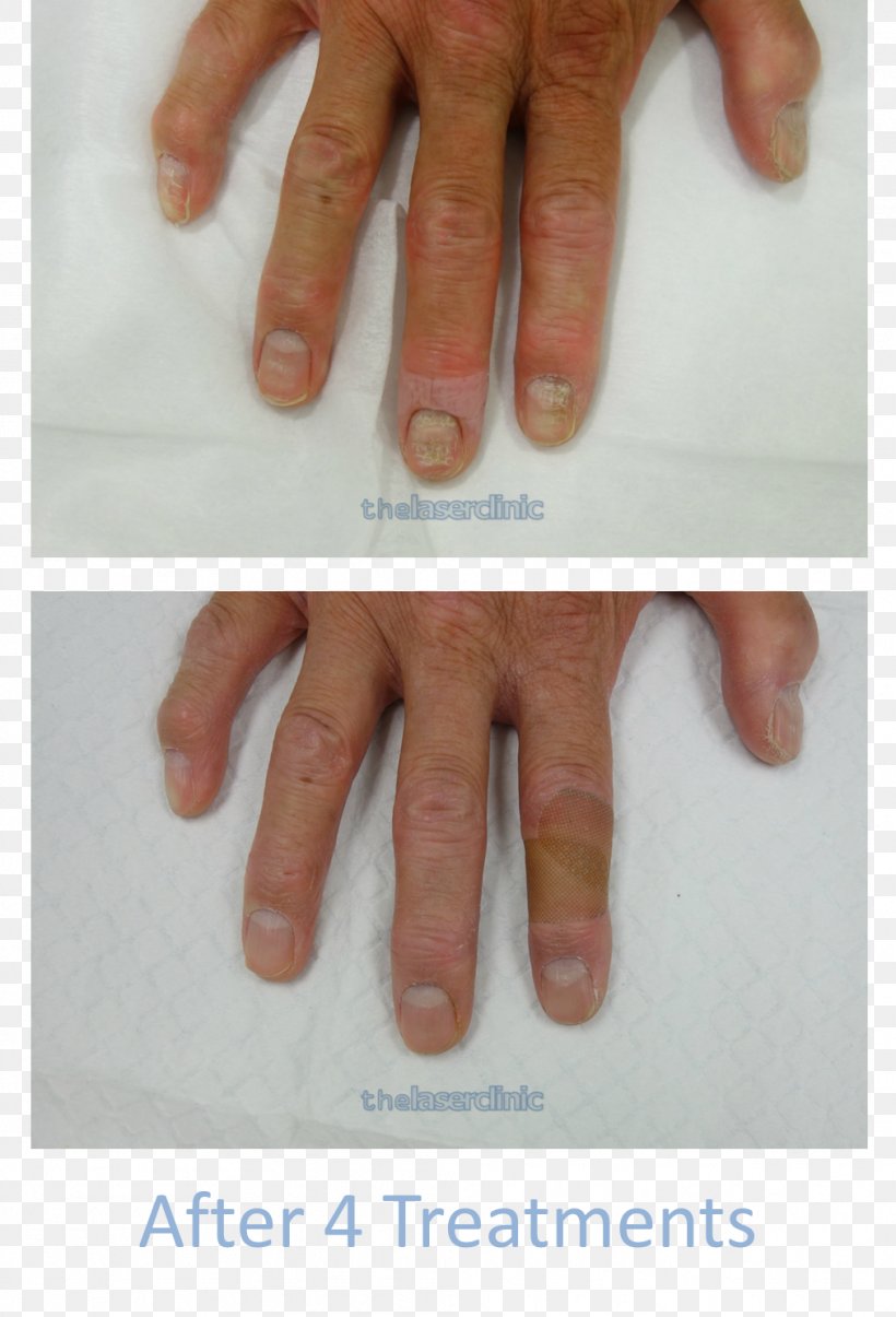 Nail Onychomycosis Laser Surgery, PNG, 1012x1488px, Nail, Clinic, Cordyceps, Finger, Fungus Download Free
