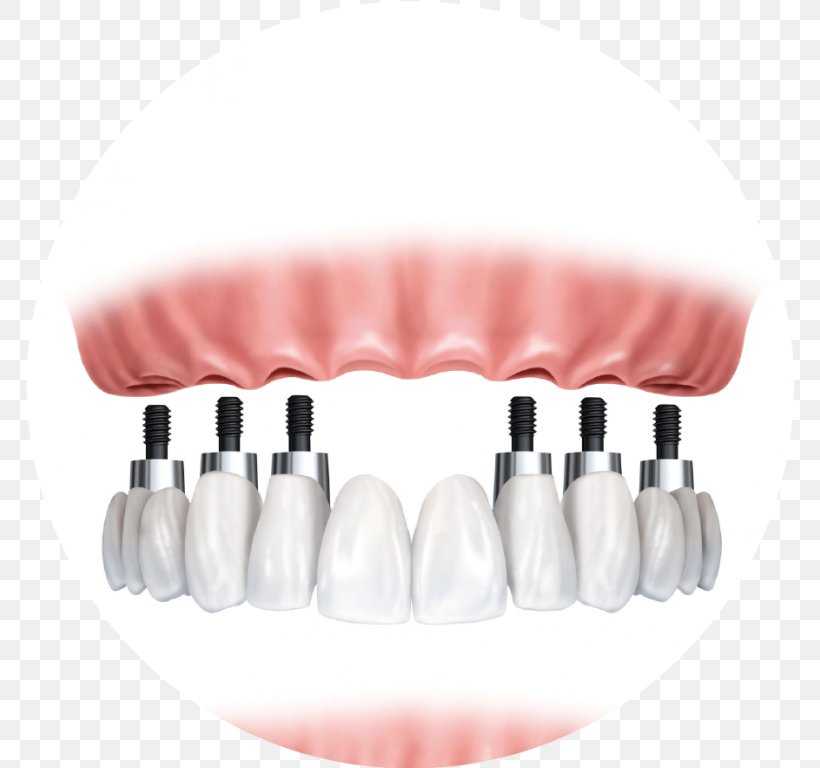 Dental Implant Dentistry Bridge Dentures, PNG, 768x768px, Dental Implant, Bridge, Crown, Dental Restoration, Dental Surgery Download Free
