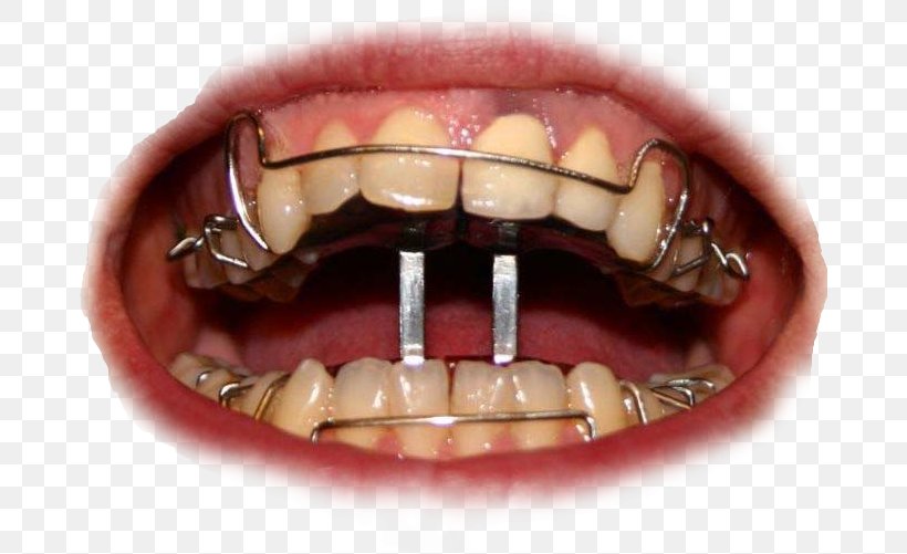 Dental Braces Orthodontics Dentistry Tooth Clear Aligners, PNG, 676x501px, Dental Braces, Clear Aligners, Crossbite, Deciduous Teeth, Dental Implant Download Free