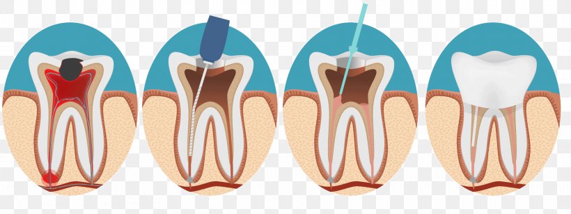 Endodontic Therapy Root Canal Endodontics Dentistry, PNG, 1763x661px,  Watercolor, Cartoon, Flower, Frame, Heart Download Free