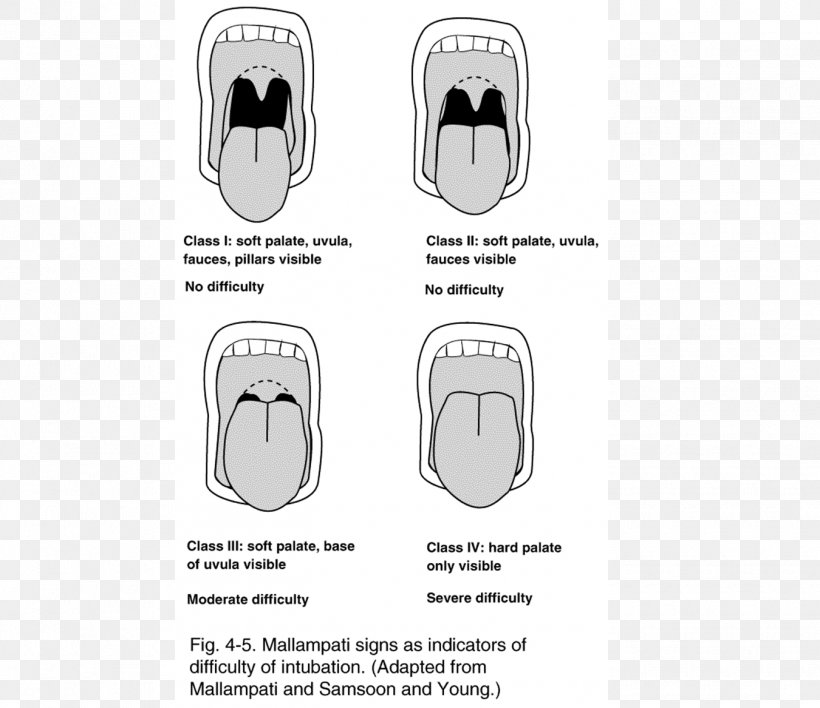 Airway Management Respiratory Tract Mallampati Score Tracheal Tube Anatomy, PNG, 1350x1167px, Airway Management, Airway, Anatomy, Diagram, Emergency Medical Technician Download Free