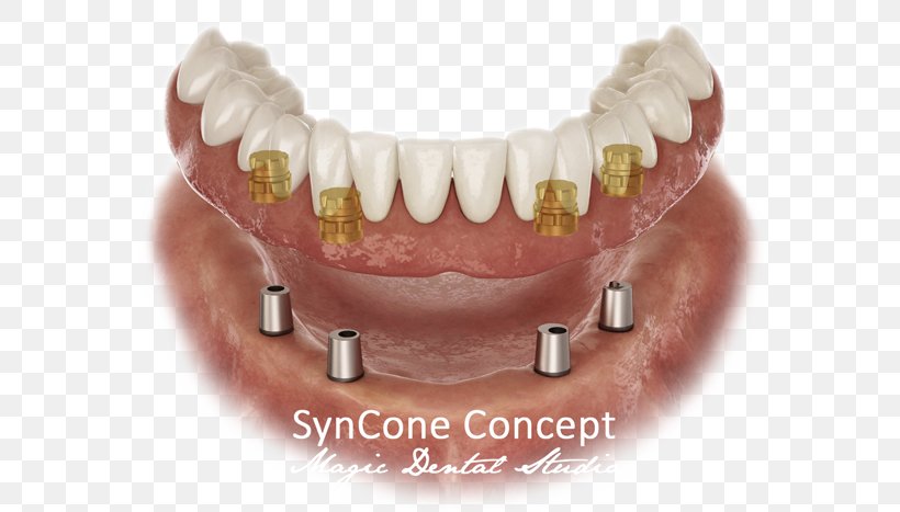 Dental Implant Dentistry Dentures Prosthesis, PNG, 600x467px, Dental Implant, Abutment, Dental Laboratory, Dentist, Dentistry Download Free