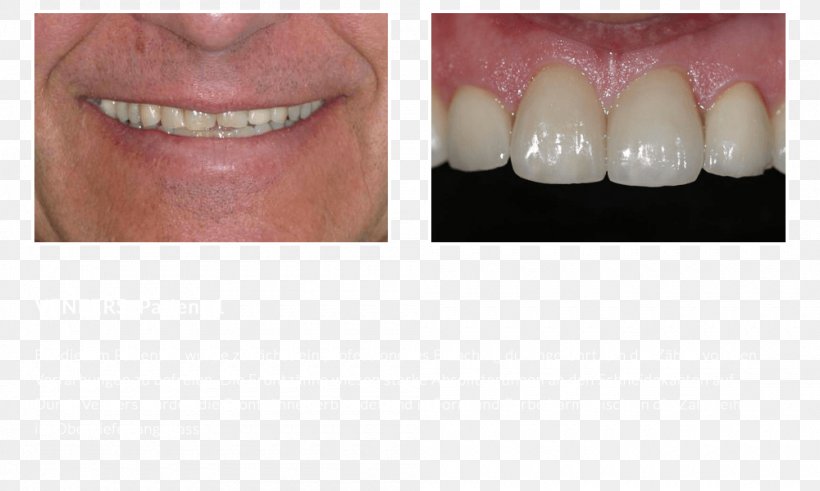 DiPura Tooth Whitening Veneer Zahnfarbe, PNG, 1000x600px, Dipura, Bridge, Chin, Cosmetic Dentistry, Demonstration Download Free
