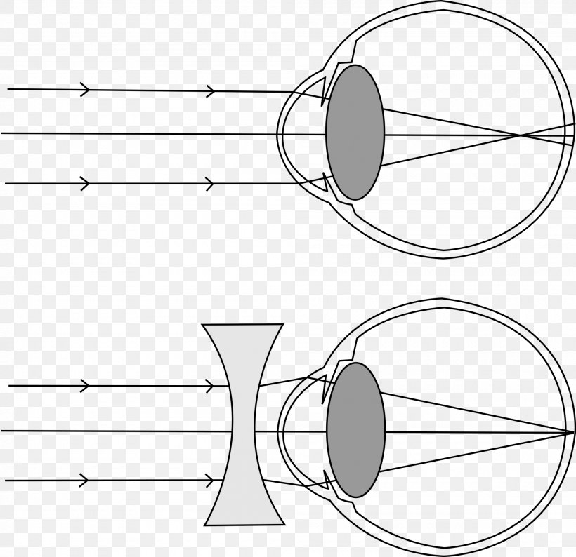 Near-sightedness Hypermetropia Visual Perception Astigmatism Human Eye, PNG, 2000x1938px, Watercolor, Cartoon, Flower, Frame, Heart Download Free
