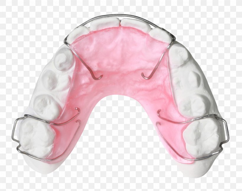 Retainer Orthodontics Orthodontic Technology Jaw Bionator, PNG, 1024x809px, Retainer, Album, Bionator, Breathing, David Gergen Download Free