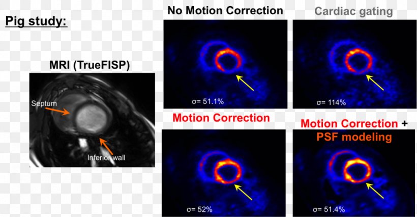 Medical Imaging Positron Emission Tomography–magnetic Resonance Imaging PET-CT Positron Emission Tomography–magnetic Resonance Imaging, PNG, 1024x532px, Medical Imaging, Brand, Cardiac Imaging, Cardiac Magnetic Resonance Imaging, Cardiology Download Free