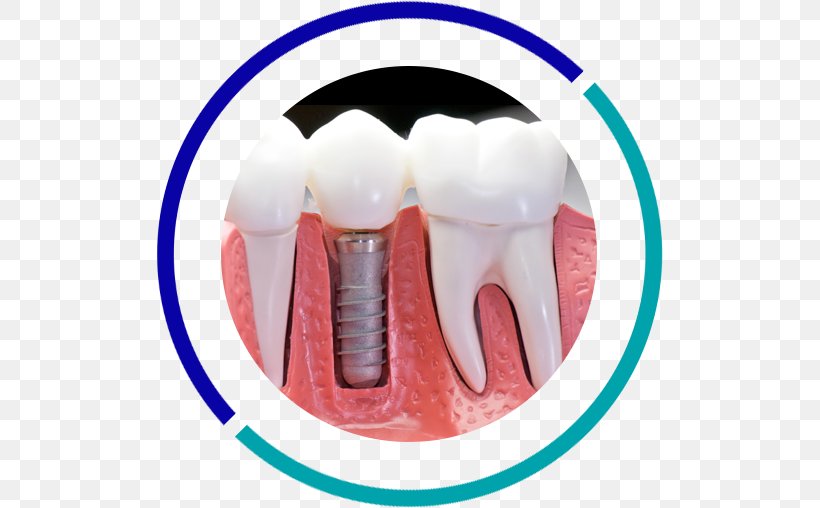 Dental Implant Dentistry Tooth, PNG, 507x508px, Dental Implant, Abutment, Biocompatibility, Bridge, Crown Download Free