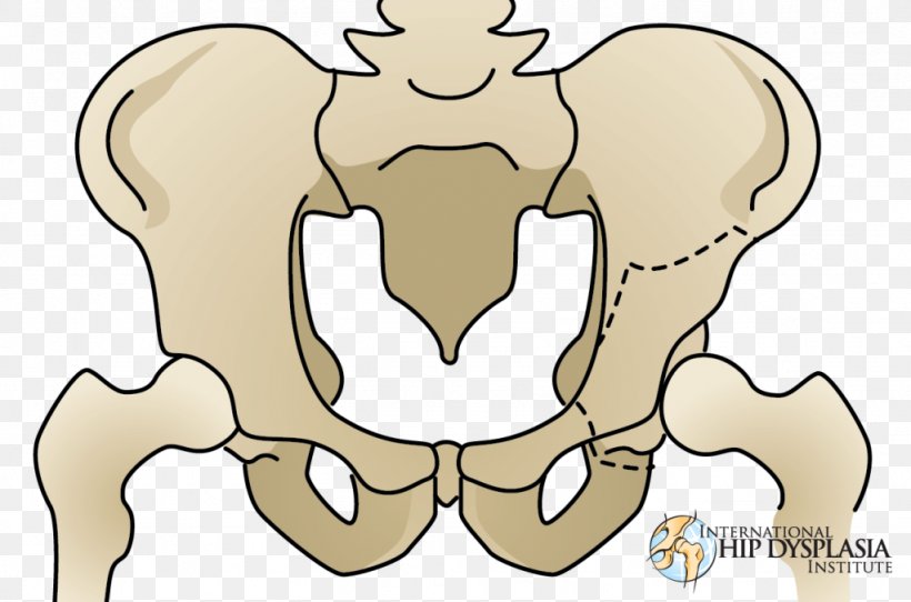 Osteotomy Hip Dysplasia Acetabulum Pelvis, PNG, 1024x678px, Watercolor, Cartoon, Flower, Frame, Heart Download Free