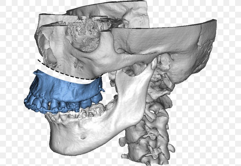 Maxilla Jaw Dysgnathie Bimaxillär Mandible, PNG, 657x566px, Watercolor, Cartoon, Flower, Frame, Heart Download Free