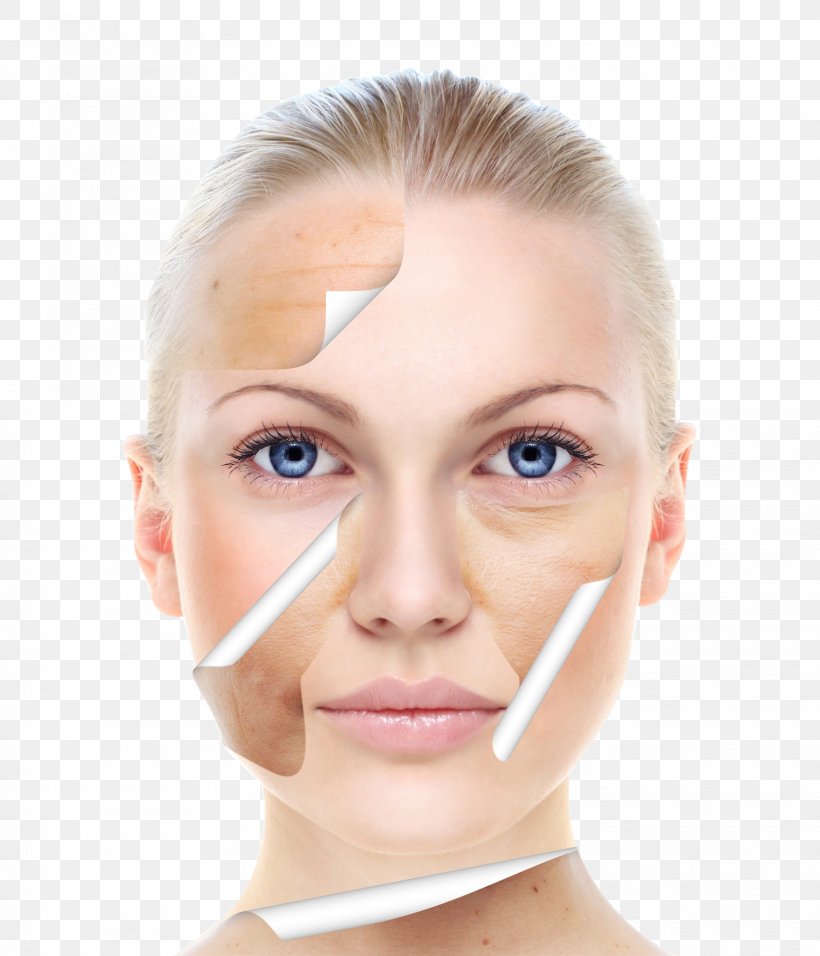 Skin Care Beauty Chemical Peel Facial, PNG, 2068x2412px, Skin, Acne, Beauty, Burn, Cheek Download Free