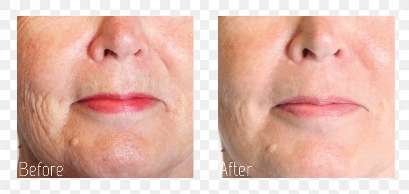 Collagen Induction Therapy Wrinkle Face Rhytidectomy, PNG, 1200x570px, Collagen Induction Therapy, Aesthetic Medicine, Antiaging Cream, Botulinum Toxin, Cheek Download Free