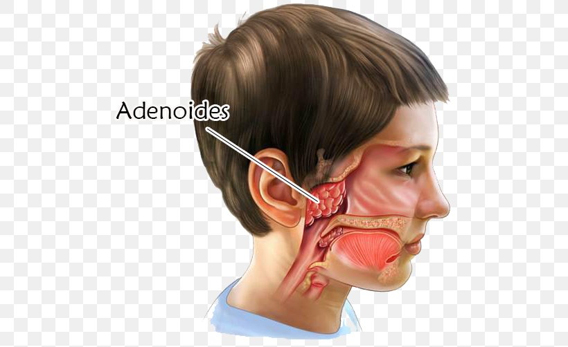 Adenoid Tonsillectomy Surgery Tonsillitis, PNG, 500x502px, Adenoid, Adenoidectomy, Cheek, Child, Chin Download Free