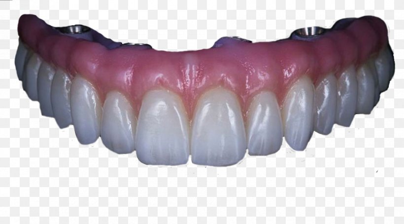 Human Tooth Angelet De Les Dents Dentures Dental Implant, PNG, 900x500px, Tooth, Angelet De Les Dents, Animaatio, Crown, Dental Implant Download Free