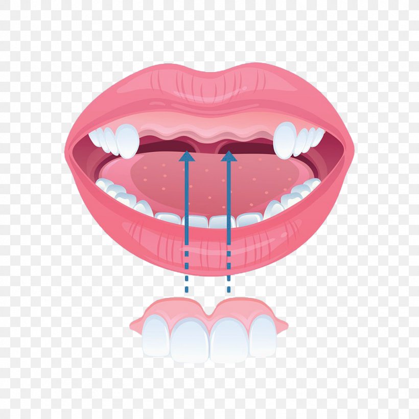 Tooth Incisor Dental Braces Dentures, PNG, 1024x1024px, Watercolor, Cartoon, Flower, Frame, Heart Download Free