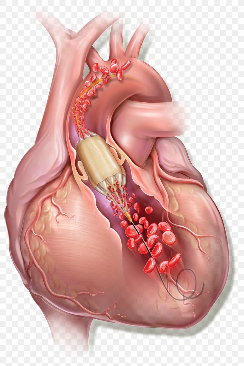 Balloon Catheter Balloon Valvuloplasty C. R. Bard Heart, PNG, 1004x1506px, Watercolor, Cartoon, Flower, Frame, Heart Download Free