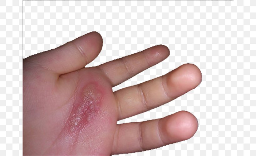 Hand Nail Thumb, PNG, 676x500px, Hand, Burn, Finger, Hand Model, Inflammation Download Free