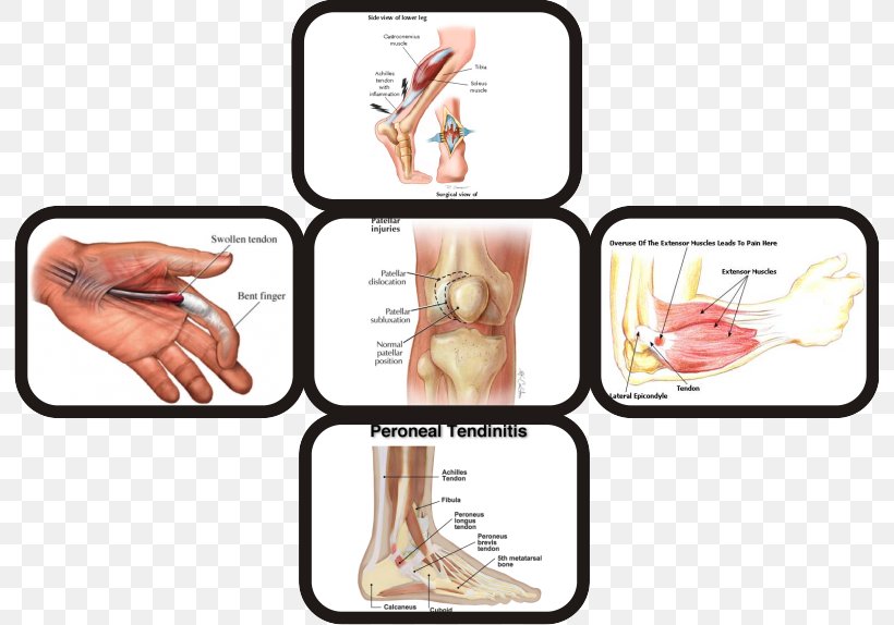 Tendon Type I Collagen Tendinopathy Finger, PNG, 793x574px, Watercolor, Cartoon, Flower, Frame, Heart Download Free