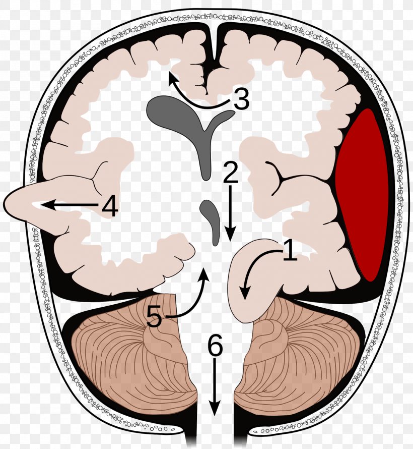 Brain Herniation Intracranial Pressure Brain Tumor Uncus, PNG, 1474x1600px, Watercolor, Cartoon, Flower, Frame, Heart Download Free