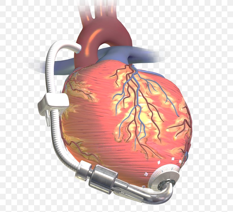Ventricular Assist Device Heart Transplantation Artificial Heart Hardware Pumps, PNG, 678x744px, Watercolor, Cartoon, Flower, Frame, Heart Download Free