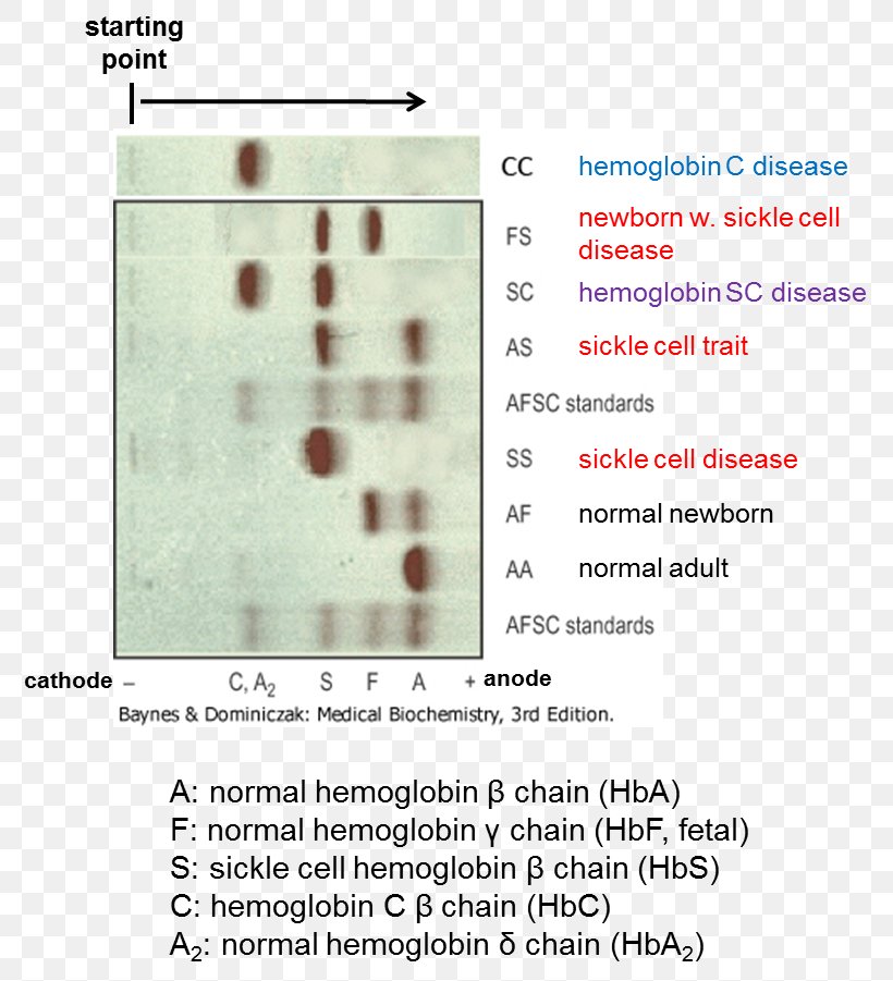 Sickle Cell Disease Hemoglobin C Hemoglobinopathy Hemoglobin Electrophoresis, PNG, 805x901px, Sickle Cell Disease, Agarose, Area, Diagram, Disease Download Free