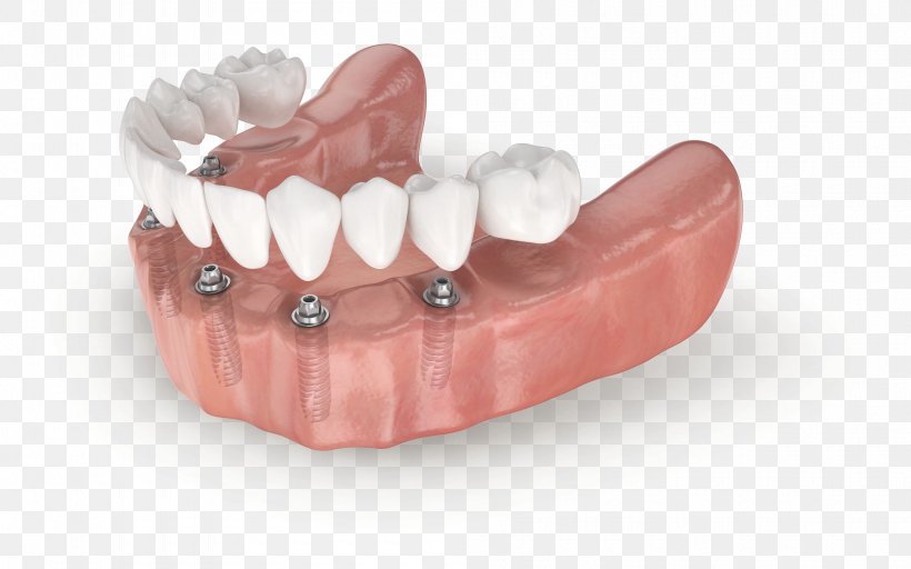 Tooth All-on-4 Dental Implant Dentistry Edentulism, PNG, 4000x2498px, Tooth, Bridge, Dental Implant, Dentistry, Dentures Download Free