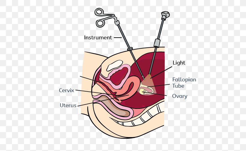 Uterine Fibroid Laparoscopy Uterine Myomectomy Endometriosis Laparotomy, PNG, 600x503px, Watercolor, Cartoon, Flower, Frame, Heart Download Free