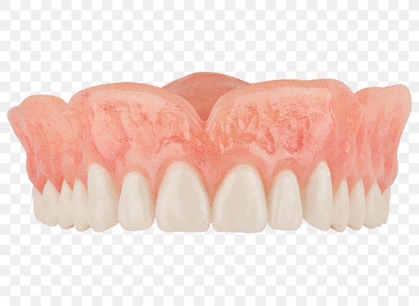 Tooth Dentures Dentistry Removable Partial Denture, PNG, 800x600px, Tooth, Aspen Dental, Dental Implant, Dentist, Dentistry Download Free