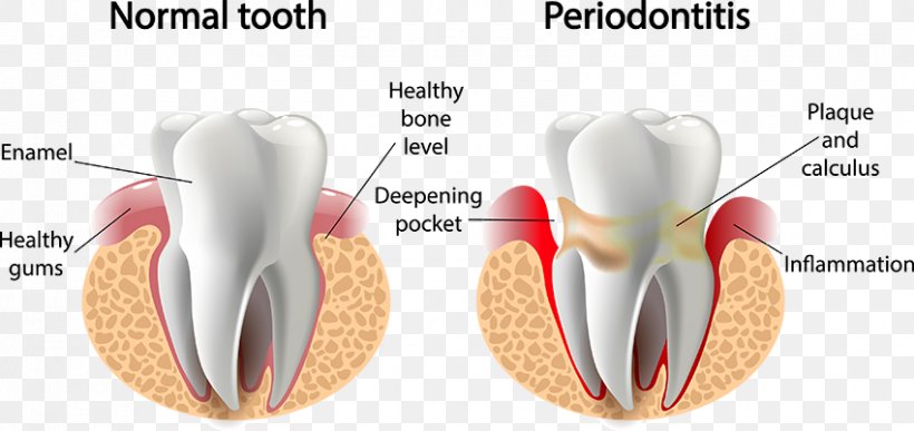 Periodontal Disease Gums Periodontology Dentistry, PNG, 850x402px, Watercolor, Cartoon, Flower, Frame, Heart Download Free