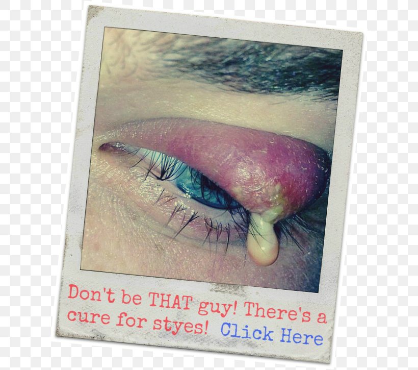 Stye Eyelid Chalazion Warm Compress, PNG, 625x725px, Stye, Acne, Antibiotics, Boil, Chalazion Download Free