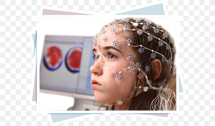 Electroencephalography Epilepsy Meningioma Disease Symptom, PNG, 602x479px, Electroencephalography, Brain, Brain Tumor, Cheek, Child Download Free