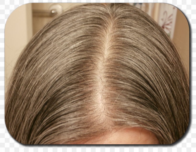 Hair Loss Blond Hair Coloring Human Hair Growth, PNG, 1319x1028px, Hair Loss, Blond, Brown Hair, Eye Shadow, Forehead Download Free