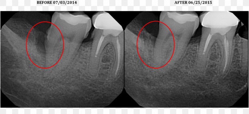 Laser-assisted New Attachment Procedure Surgery Periodontology X-ray, PNG, 1294x595px, Surgery, Black And White, Bone, Diet, Disease Download Free