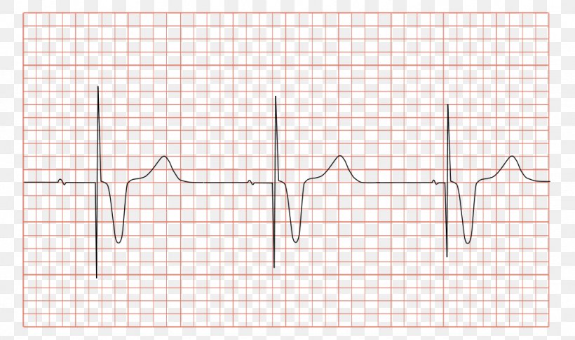 Artificial Cardiac Pacemaker Electrocardiography Pacemaker Syndrome Multifocal Atrial Tachycardia Medicine, PNG, 1024x607px, Watercolor, Cartoon, Flower, Frame, Heart Download Free