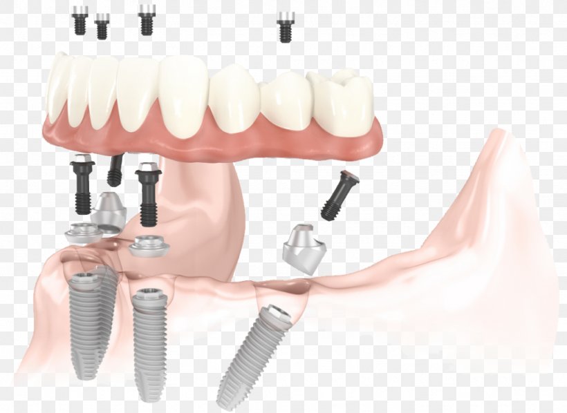 All-on-4 Dental Implant Dentistry, PNG, 1024x748px, Dental Implant, Abutment, Bridge, Brush, Dentist Download Free