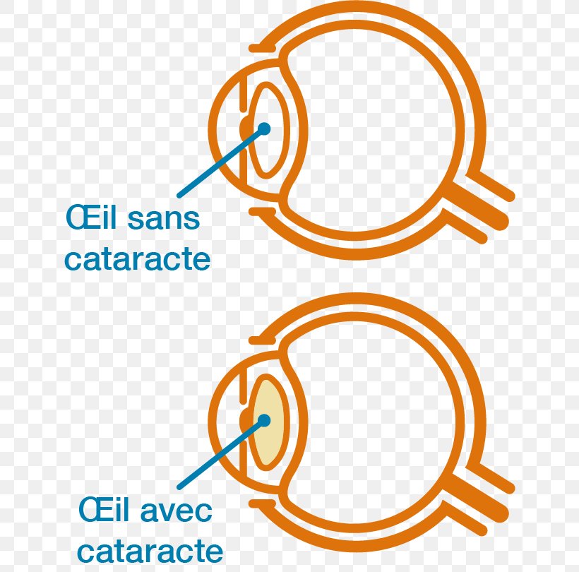 Cataract Vector Graphics Clip Art Stock Illustration, PNG, 640x810px, Cataract, Area, Brand, Cataract Surgery, Diagram Download Free