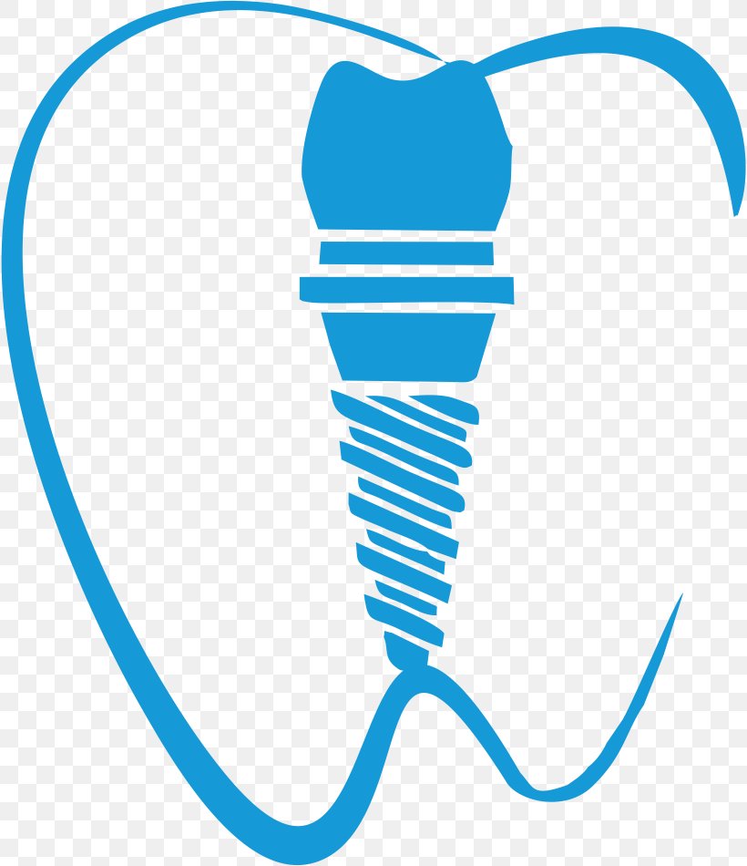 Dental Implant Dentistry Tooth Clip Art, PNG, 818x950px, Dental Implant, Area, Cosmetic Dentistry, Crown, Dentist Download Free