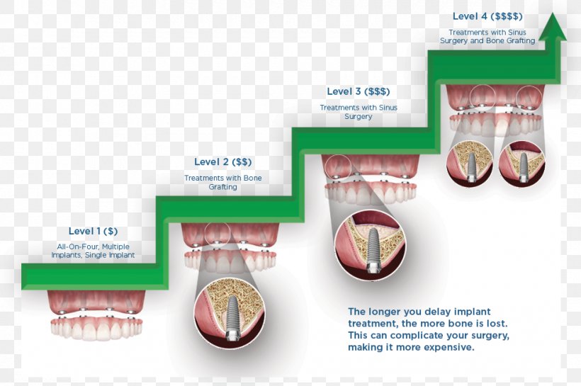 Dental Implant Dentistry Dental Insurance Bridge, PNG, 980x652px, Dental Implant, Bone, Brand, Bridge, Cost Download Free